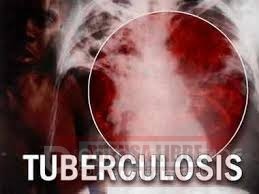 130 casos de tuberculosis se registran en Casanare