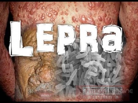 60 nuevos casos de lepra se han presentado en los últimos años en Casanare