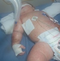 Bebé con cuadro de desnutrición internado en UCI del Hospital requiere solidaridad 