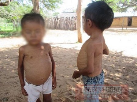 Casanare registra este año 294 casos de desnutrición aguda en niños menores de 5 años