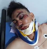 En estado grave en la UCI del hospital de Yopal permanece joven accidentado por camioneta al servicio del Alcalde de Maní