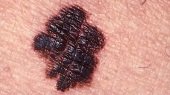 En 2020 se esperaran 102 casos nuevos de cáncer de piel por cada 100 mil habitantes