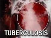 90 casos de tuberculosis se registran actualmente en Casanare