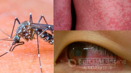 Siguen elevándose estadísticas de casos de Zika. En Yopal se presenta el mayor número de casos