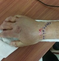 En estado crítico en el Hospital de Yopal permanece mujer atacada con machete por su expareja