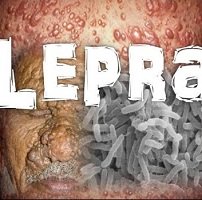 60 nuevos casos de lepra se han presentado en los últimos años en Casanare