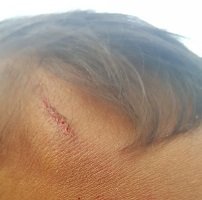 Perro Pitbull atacó a niño de 2 años en Yopal causándole lesiones en su rostro