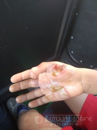 Brutal castigo a un niño en Yopal le dejó quemaduras de segundo y tercer grado en una de sus manos