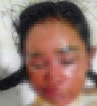 Solicitan ayudas para niña de Orocué que sufrió graves quemaduras
