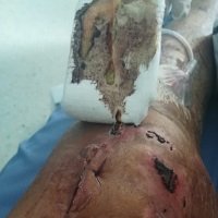 A punto de que le sea amputada una pierna paciente pide a la Nueva EPS urgente remisión